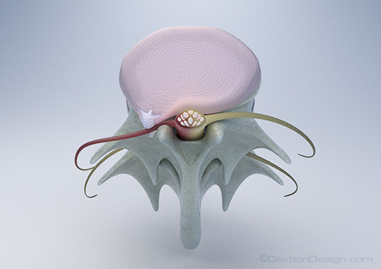 Herniated Disc